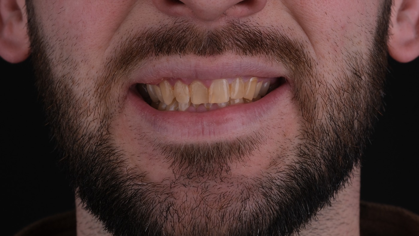 Before